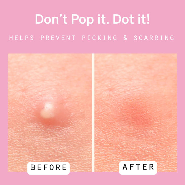 Dot Pimple Patches